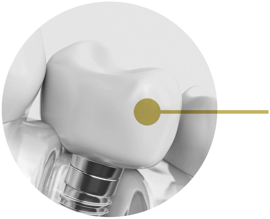 Maintaining Oral Hygiene With Dental Implants