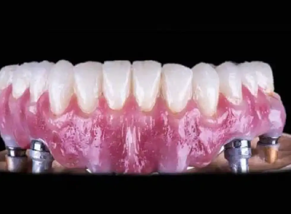 The Advantages Of Choosing Dental Implants Over Dentures